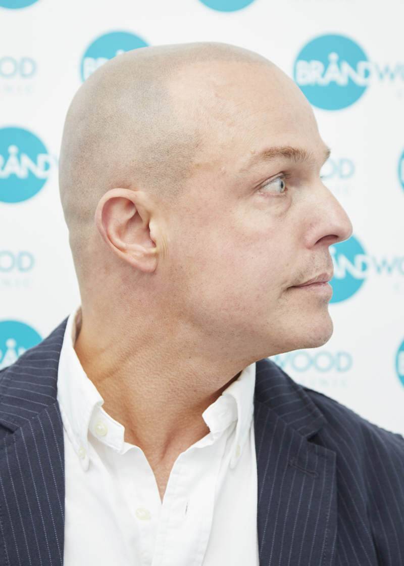 Jon: After Treatment for Alopecia