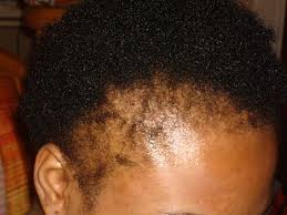 Traction Alopecia: Before