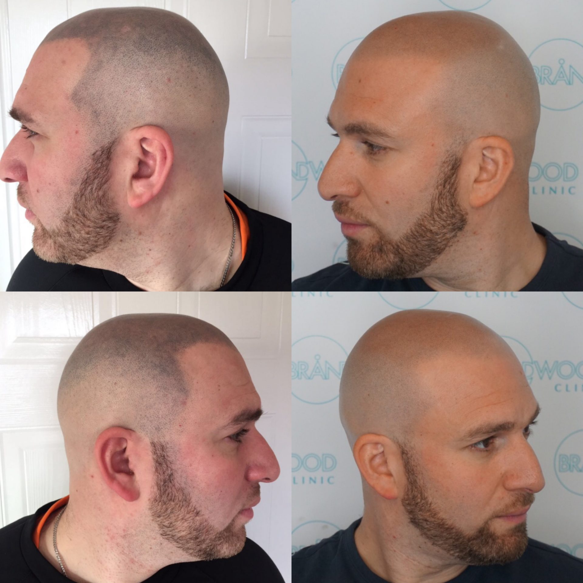 Chris: Before & After Treatment