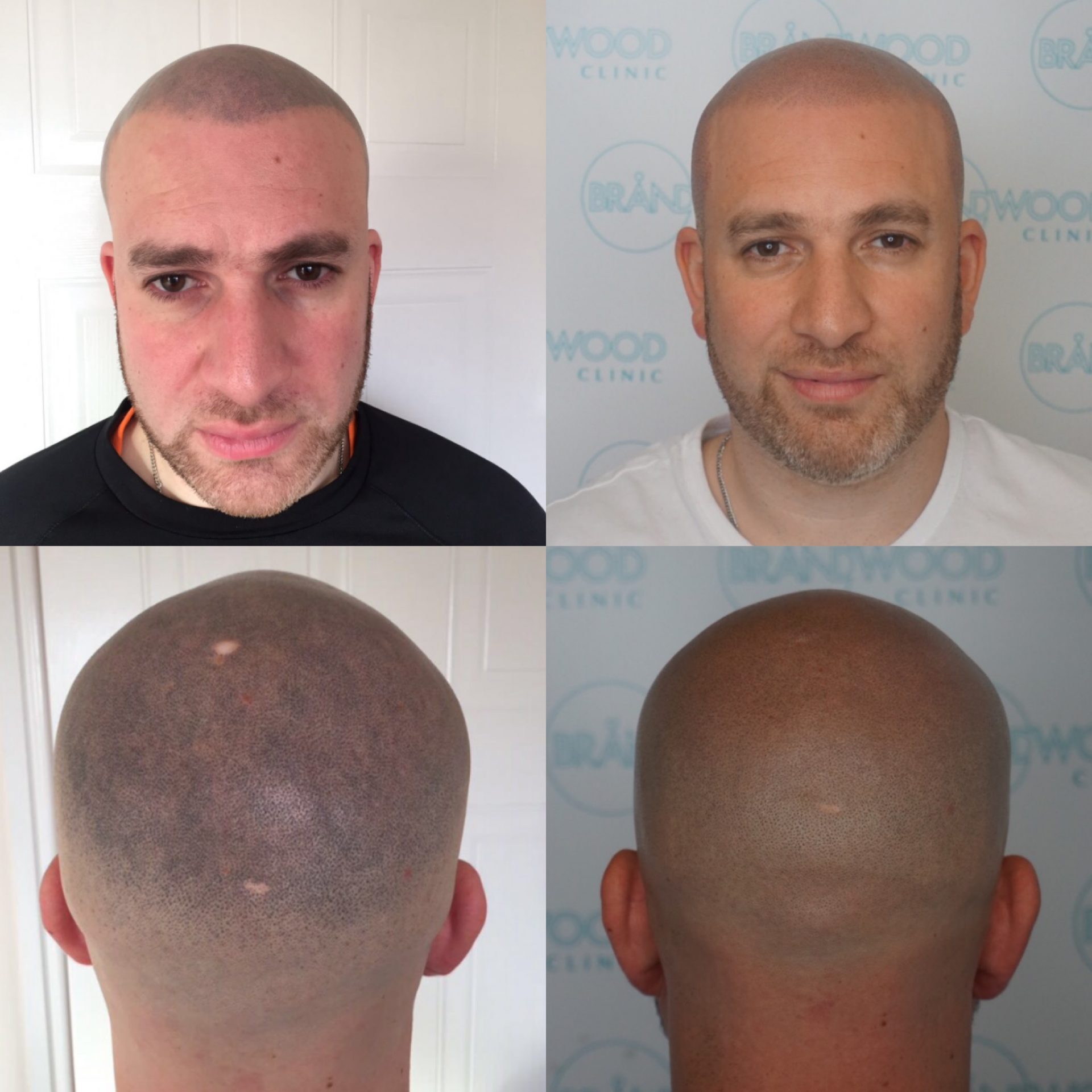 Chris: Before & After Treatment