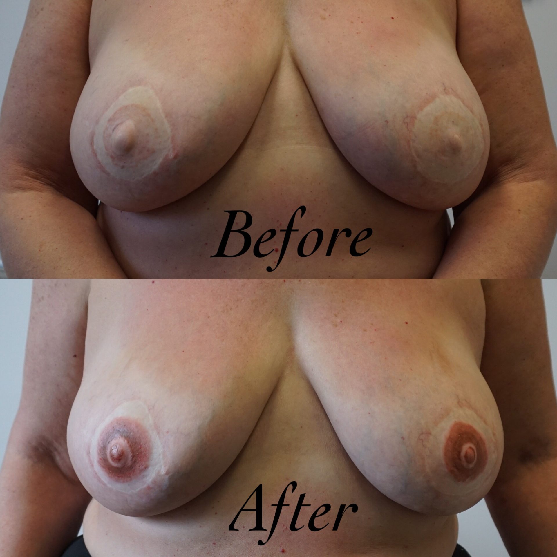 Before & After: Areola re-pigmentation